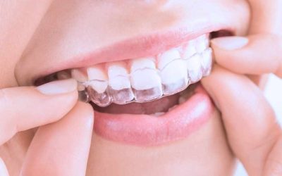 Invisalign®: Il Sorriso Perfetto Senza Ferretti