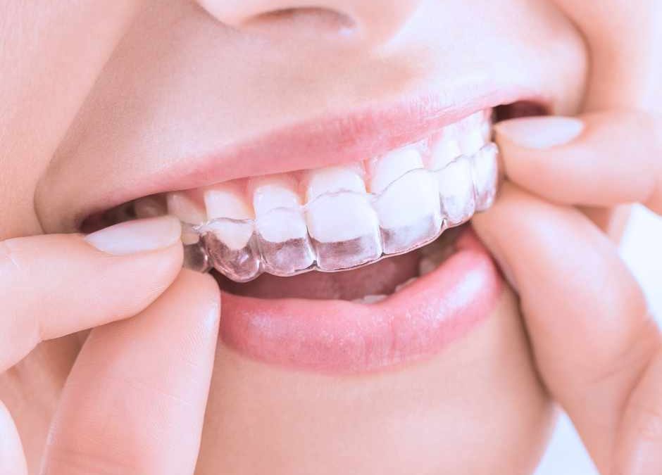 Invisalign®